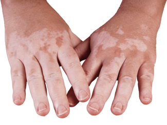 Vitiligo